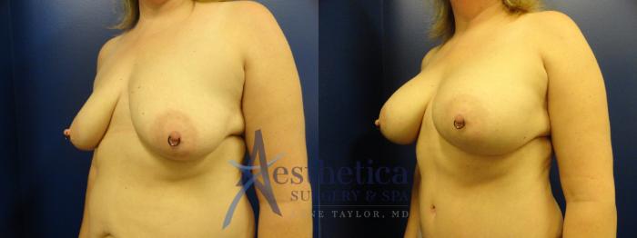 Breast Augmentation Case 328 Before & After View #2 | Columbus, OH | Aesthetica Surgery & Spa