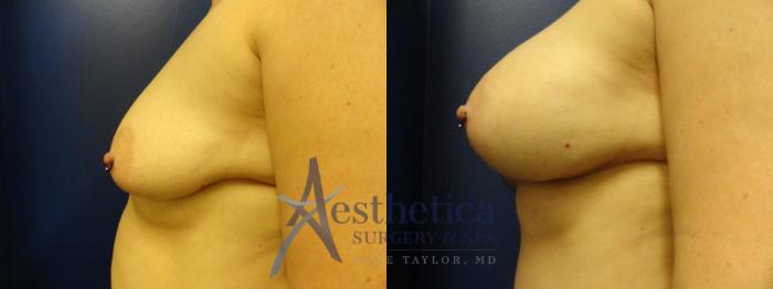 Breast Augmentation Case 328 Before & After View #3 | Columbus, OH | Aesthetica Surgery & Spa
