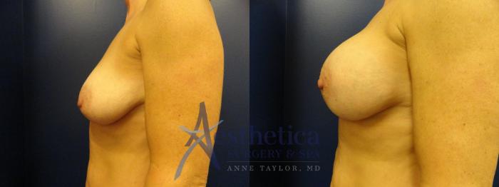 Breast Augmentation Case 329 Before & After View #3 | Columbus, OH | Aesthetica Surgery & Spa