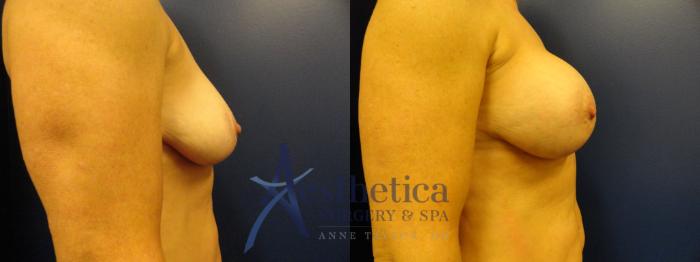 Breast Augmentation Case 329 Before & After View #4 | Columbus, OH | Aesthetica Surgery & Spa