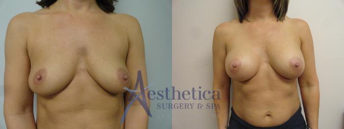 Breast Augmentation Case 34 Before & After View #1 | Columbus, OH | Aesthetica Surgery & Spa