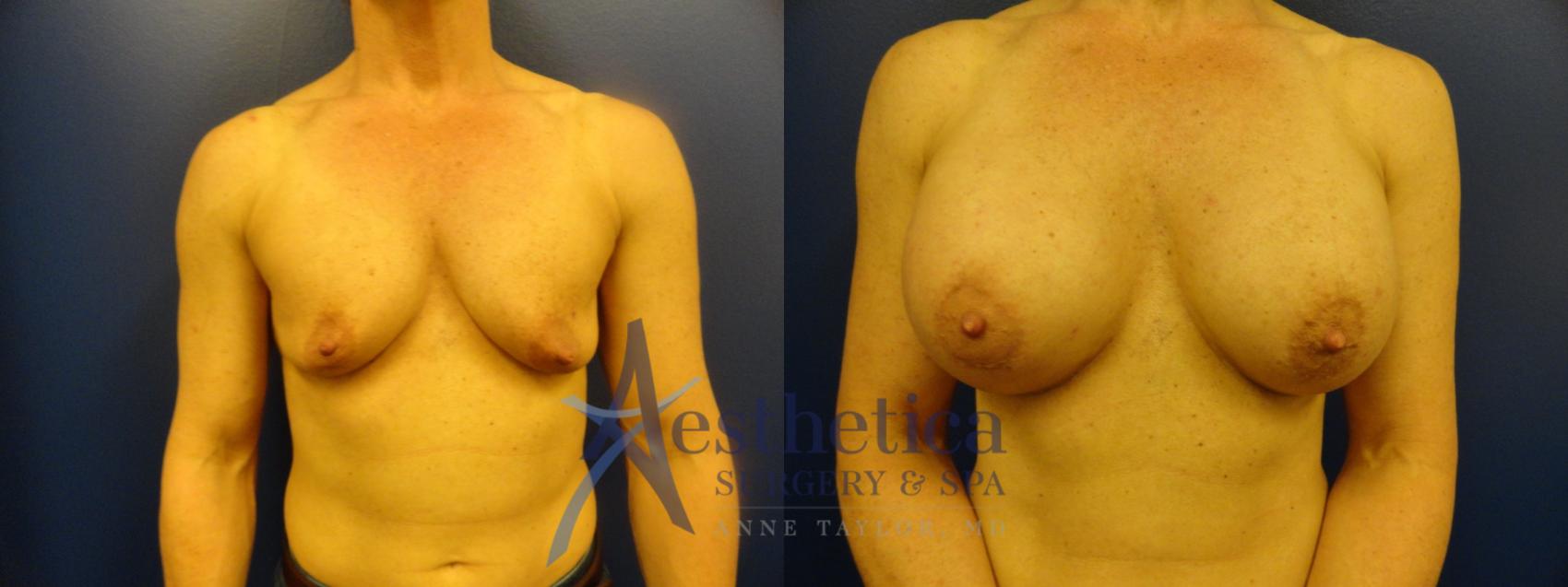 Breast Augmentation Case 340 Before & After View #1 | Columbus, OH | Aesthetica Surgery & Spa