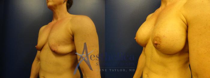 Breast Augmentation Case 340 Before & After View #2 | Columbus, OH | Aesthetica Surgery & Spa