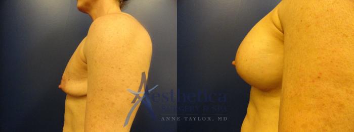 Breast Augmentation Case 340 Before & After View #3 | Columbus, OH | Aesthetica Surgery & Spa