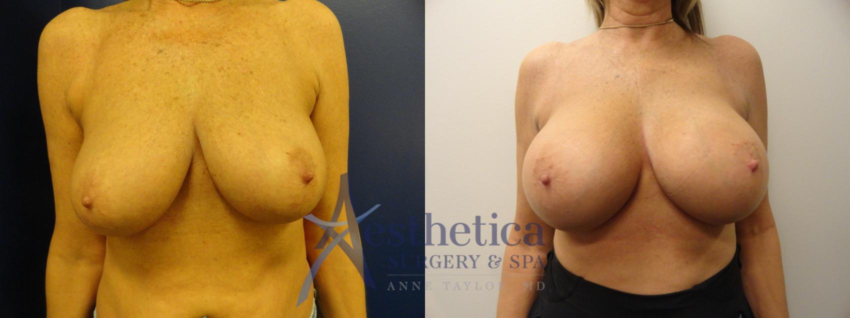 Breast Augmentation Case 341 Before & After View #1 | Worthington, OH | Aesthetica Surgery & Spa