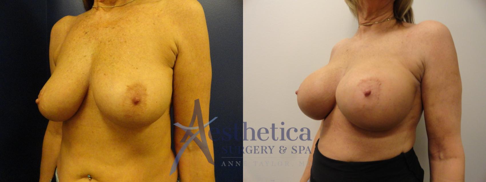 Breast Augmentation Case 341 Before & After View #2 | Worthington, OH | Aesthetica Surgery & Spa