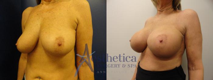 Breast Augmentation Case 341 Before & After View #2 | Columbus, OH | Aesthetica Surgery & Spa