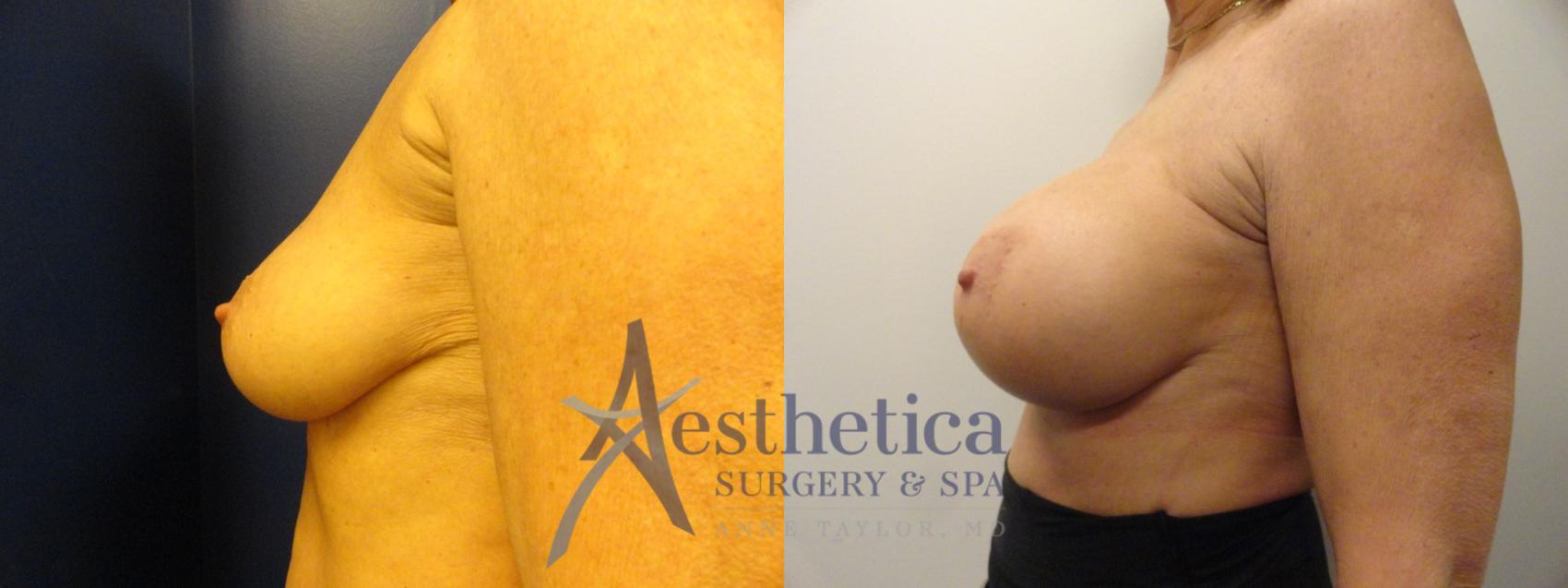 Breast Augmentation Case 341 Before & After View #3 | Worthington, OH | Aesthetica Surgery & Spa