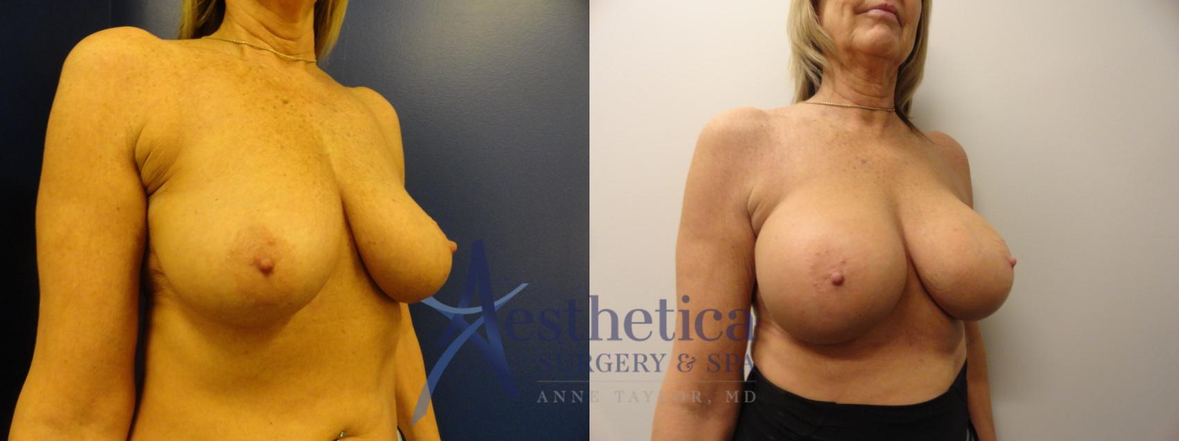 Breast Augmentation Case 341 Before & After View #4 | Worthington, OH | Aesthetica Surgery & Spa