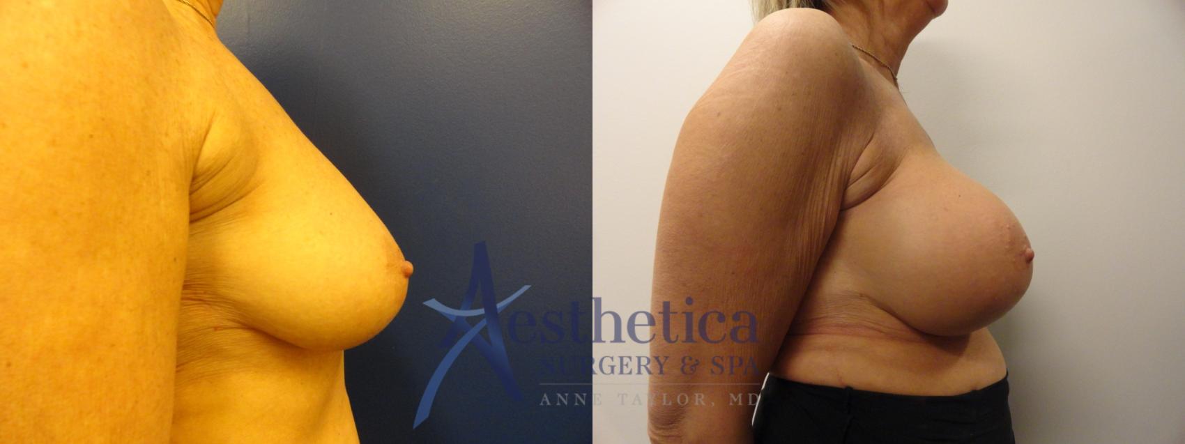 Breast Augmentation Case 341 Before & After View #5 | Worthington, OH | Aesthetica Surgery & Spa
