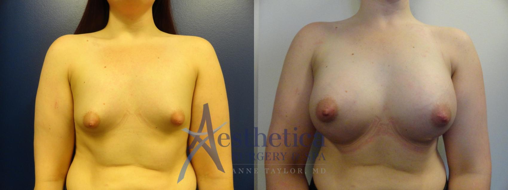 Breast Augmentation Case 369 Before & After View #1 | Columbus, OH | Aesthetica Surgery & Spa