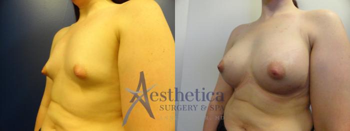Breast Augmentation Case 369 Before & After View #2 | Columbus, OH | Aesthetica Surgery & Spa