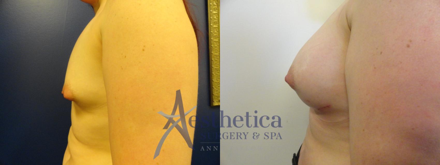 Breast Augmentation Case 369 Before & After View #3 | Columbus, OH | Aesthetica Surgery & Spa