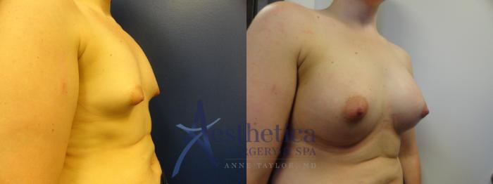 Breast Augmentation Case 369 Before & After View #4 | Columbus, OH | Aesthetica Surgery & Spa