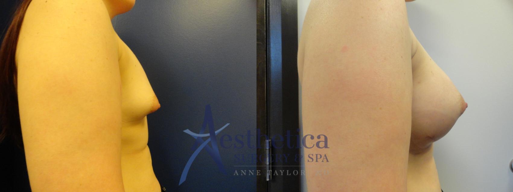 Breast Augmentation Case 369 Before & After View #5 | Columbus, OH | Aesthetica Surgery & Spa