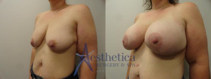 Breast Augmentation Case 370 Before & After View #2 | Columbus, OH | Aesthetica Surgery & Spa