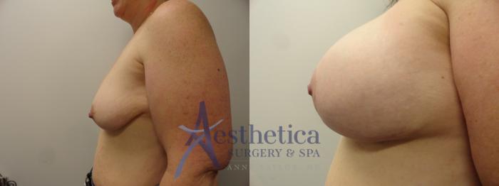 Breast Augmentation Case 370 Before & After View #3 | Columbus, OH | Aesthetica Surgery & Spa