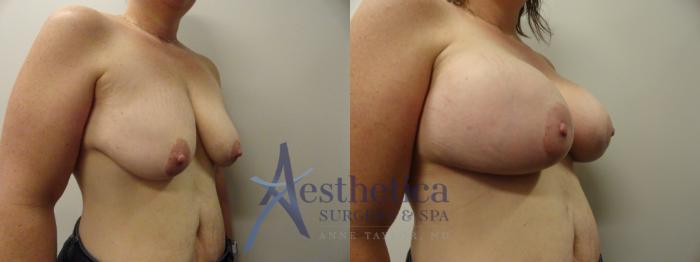 Breast Augmentation Case 370 Before & After View #4 | Columbus, OH | Aesthetica Surgery & Spa