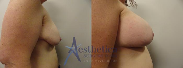 Breast Augmentation Case 370 Before & After View #5 | Columbus, OH | Aesthetica Surgery & Spa