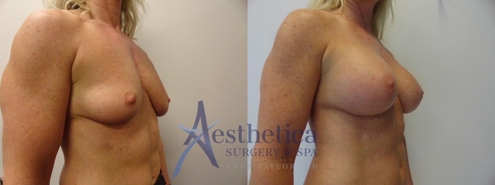 Breast Augmentation Case 371 Before & After View #2 | Worthington, OH | Aesthetica Surgery & Spa