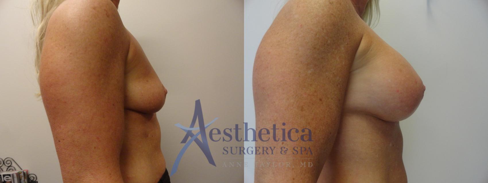 Breast Augmentation Case 371 Before & After View #3 | Worthington, OH | Aesthetica Surgery & Spa