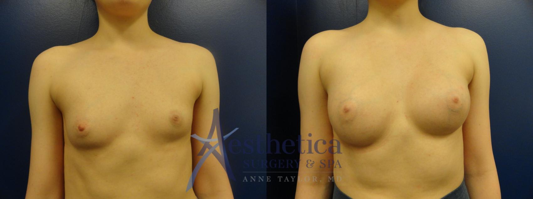 Breast Augmentation Case 372 Before & After View #1 | Worthington, OH | Aesthetica Surgery & Spa
