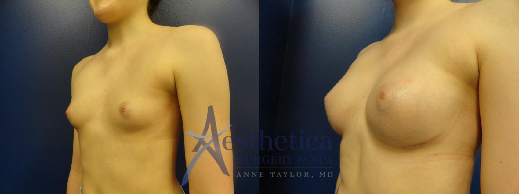 Breast Augmentation Case 372 Before & After View #2 | Worthington, OH | Aesthetica Surgery & Spa