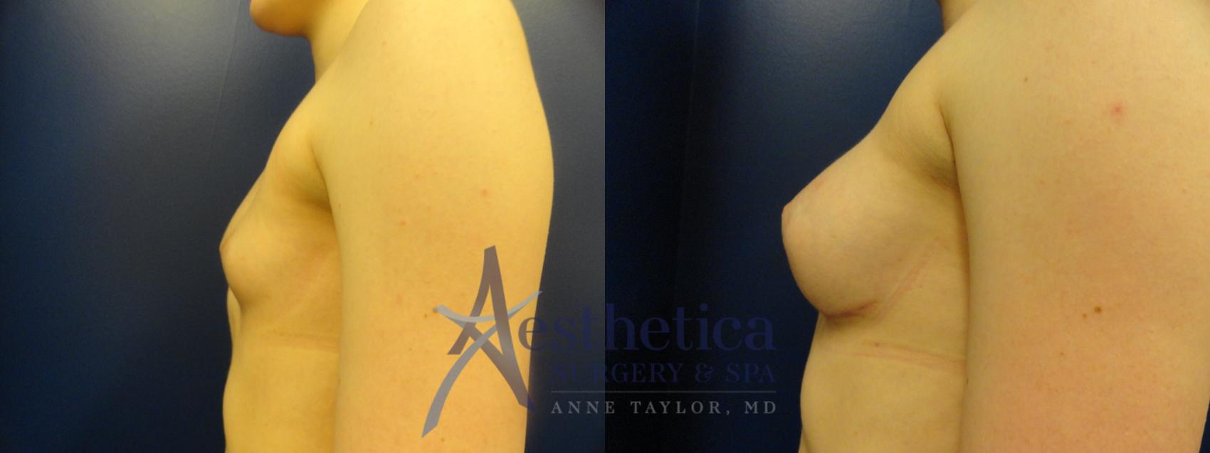 Breast Augmentation Case 372 Before & After View #3 | Worthington, OH | Aesthetica Surgery & Spa
