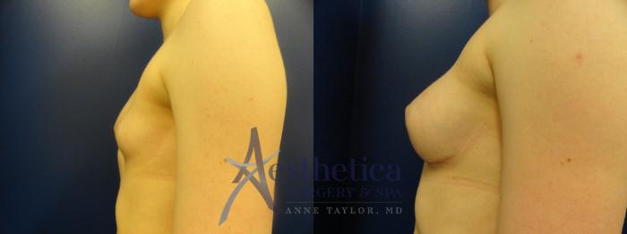Breast Augmentation Case 372 Before & After View #3 | Columbus, OH | Aesthetica Surgery & Spa