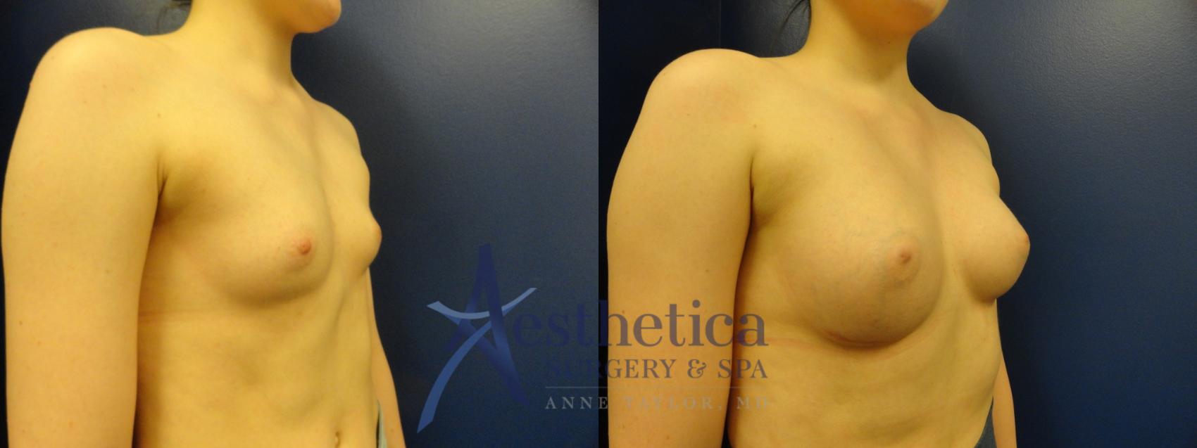 Breast Augmentation Case 372 Before & After View #4 | Worthington, OH | Aesthetica Surgery & Spa