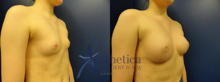 Breast Augmentation Case 372 Before & After View #4 | Columbus, OH | Aesthetica Surgery & Spa