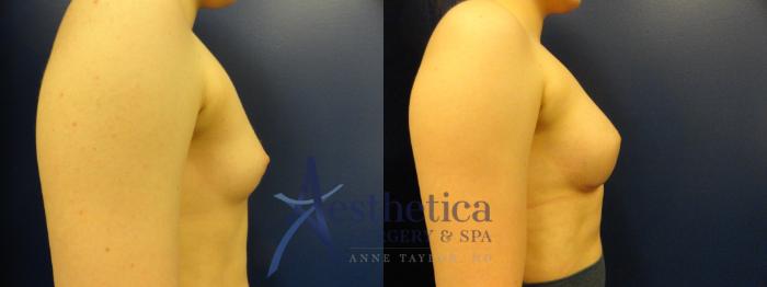 Breast Augmentation Case 372 Before & After View #5 | Columbus, OH | Aesthetica Surgery & Spa