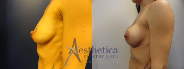 Breast Augmentation Case 373 Before & After View #3 | Columbus, OH | Aesthetica Surgery & Spa