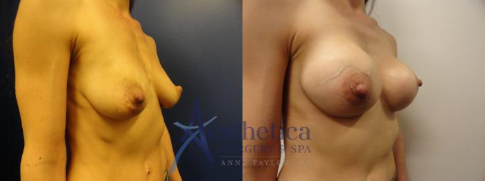 Breast Augmentation Case 373 Before & After View #4 | Columbus, OH | Aesthetica Surgery & Spa