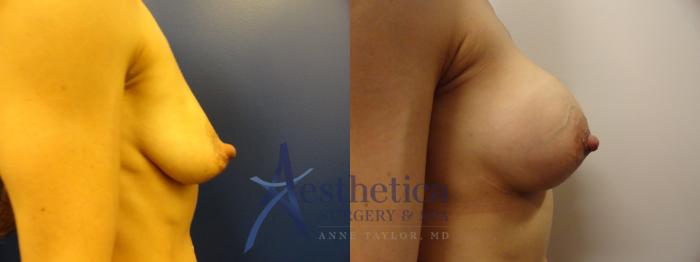 Breast Augmentation Case 373 Before & After View #5 | Columbus, OH | Aesthetica Surgery & Spa