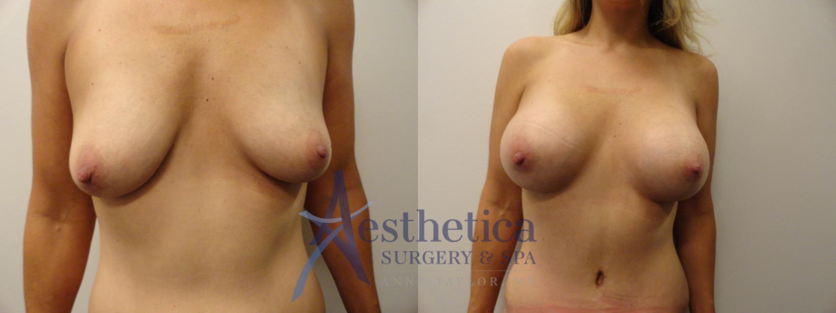 Breast Augmentation Case 374 Before & After View #1 | Worthington, OH | Aesthetica Surgery & Spa