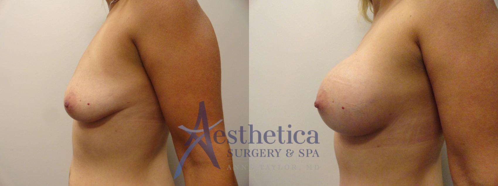 Breast Augmentation Case 374 Before & After View #3 | Worthington, OH | Aesthetica Surgery & Spa