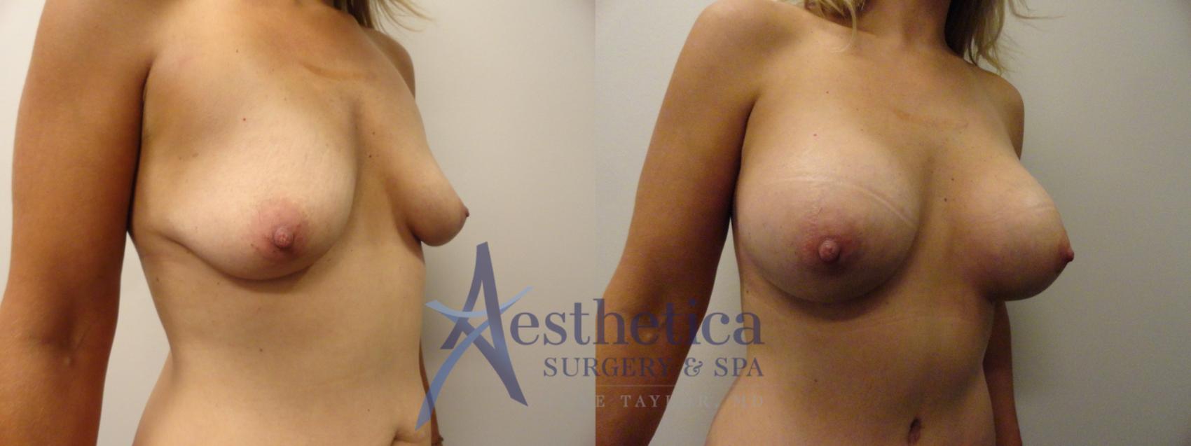 Breast Augmentation Case 374 Before & After View #4 | Worthington, OH | Aesthetica Surgery & Spa