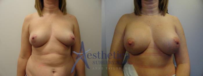 Breast Augmentation Case 375 Before & After View #1 | Columbus, OH | Aesthetica Surgery & Spa