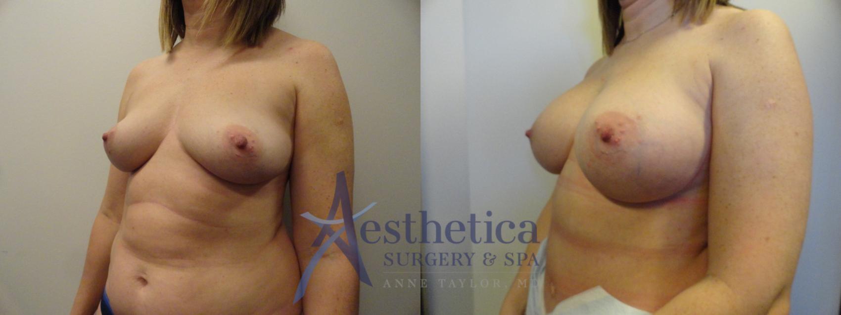 Breast Augmentation Case 375 Before & After View #2 | Worthington, OH | Aesthetica Surgery & Spa
