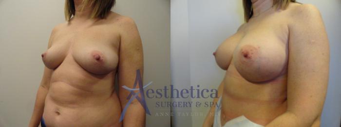 Breast Augmentation Case 375 Before & After View #2 | Columbus, OH | Aesthetica Surgery & Spa