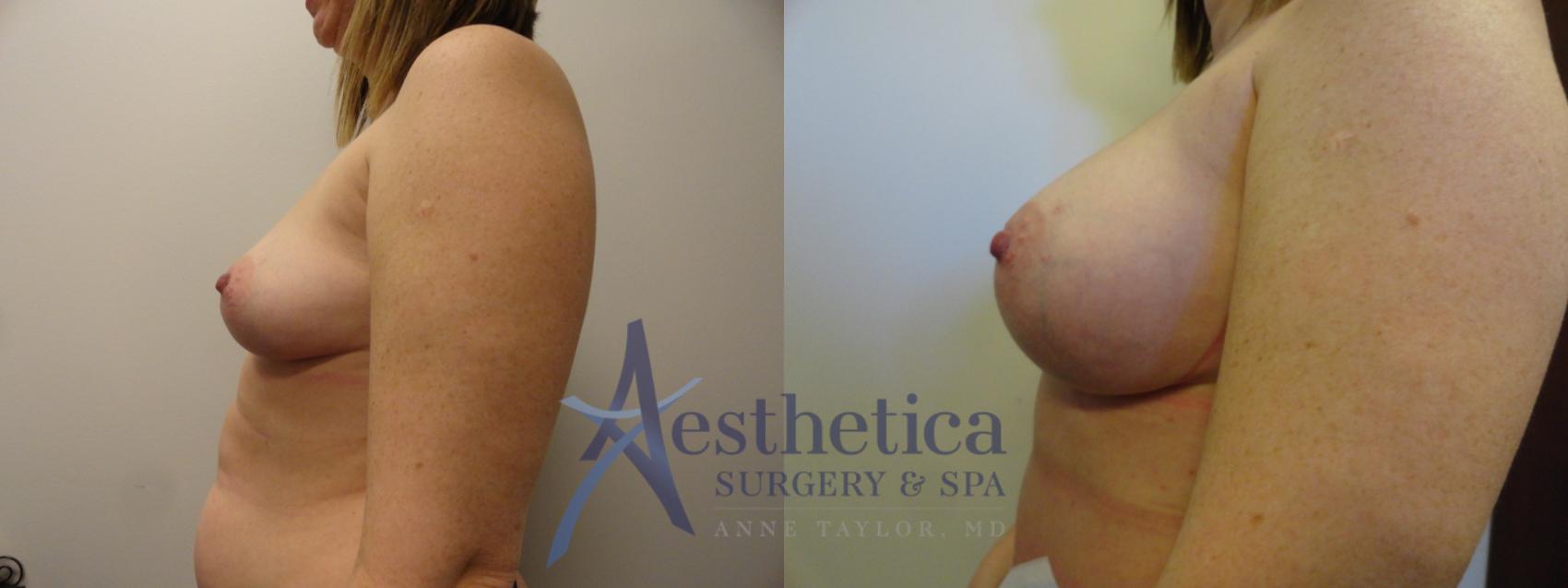 Breast Augmentation Case 375 Before & After View #3 | Worthington, OH | Aesthetica Surgery & Spa