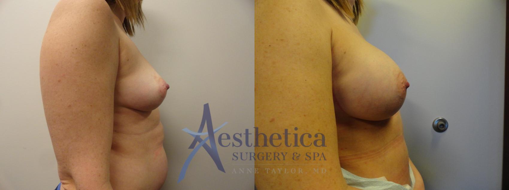 Breast Augmentation Case 375 Before & After View #5 | Worthington, OH | Aesthetica Surgery & Spa