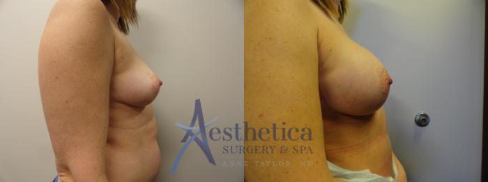 Breast Augmentation Case 375 Before & After View #5 | Columbus, OH | Aesthetica Surgery & Spa