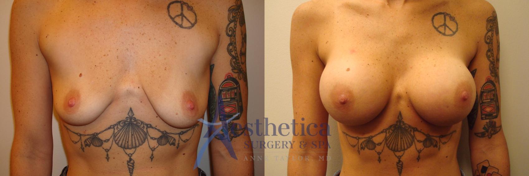 Breast Augmentation Case 376 Before & After View #1 | Worthington, OH | Aesthetica Surgery & Spa