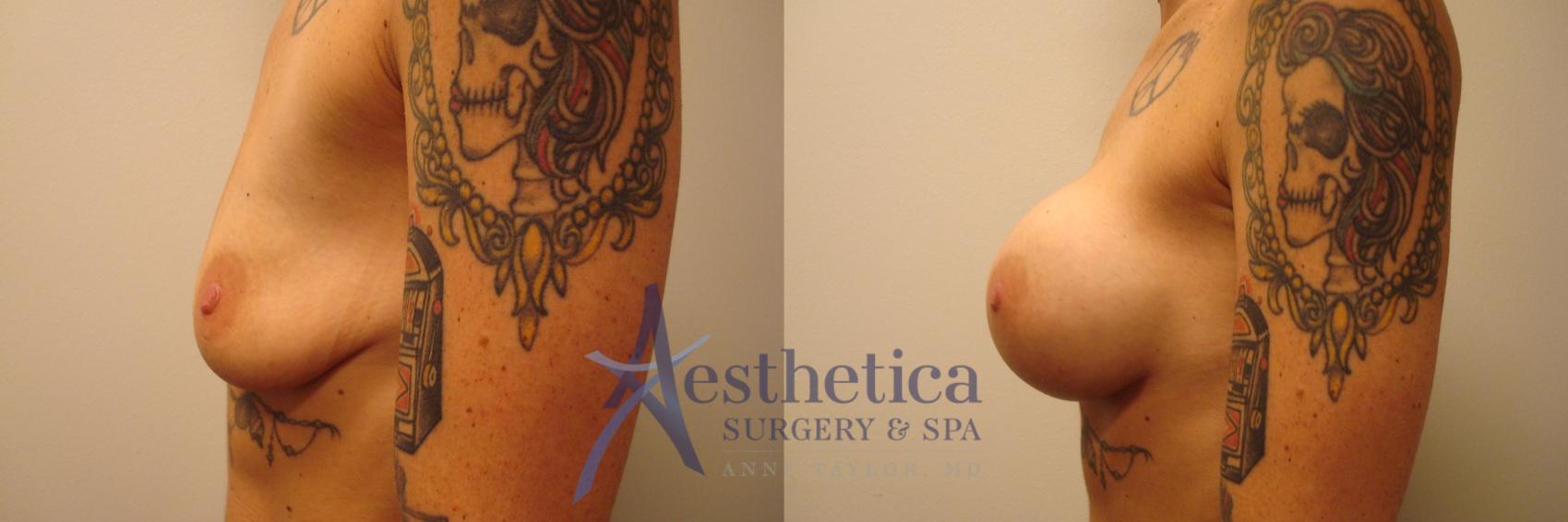 Breast Augmentation Case 376 Before & After View #3 | Worthington, OH | Aesthetica Surgery & Spa