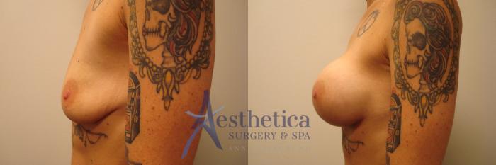 Breast Augmentation Case 376 Before & After View #3 | Columbus, OH | Aesthetica Surgery & Spa