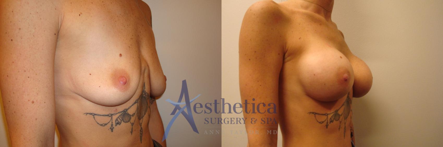 Breast Augmentation Case 376 Before & After View #4 | Worthington, OH | Aesthetica Surgery & Spa