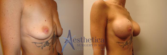 Breast Augmentation Case 376 Before & After View #4 | Columbus, OH | Aesthetica Surgery & Spa