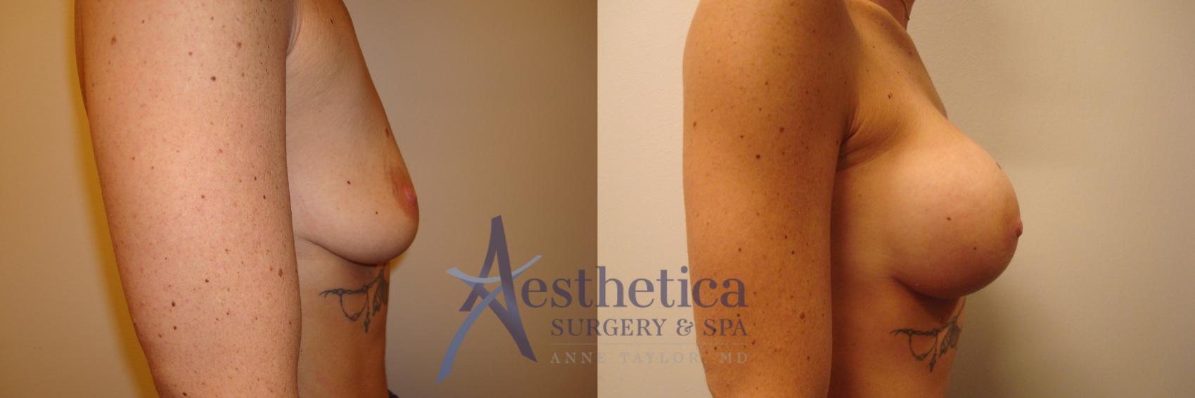Breast Augmentation Case 376 Before & After View #5 | Worthington, OH | Aesthetica Surgery & Spa